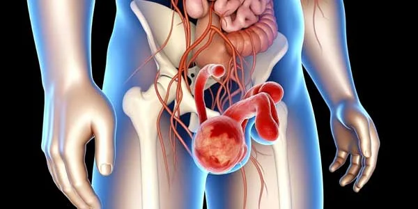 أسباب دوالى الخصية عند الرجل