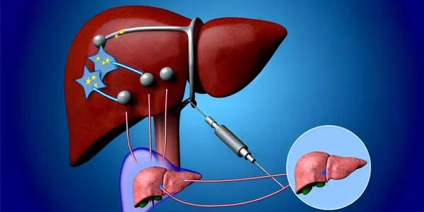 علاج أورام الكبد بالأشعة التداخلية: تقنيات حديثة و فعالية متميزة علاج أورام الكبد بالأشعة التداخلية
