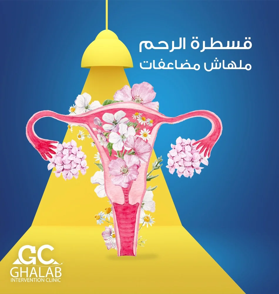 علاج الأورام الليفية مع الدكتور محمود غلاب خبير الأشعة التداخلية