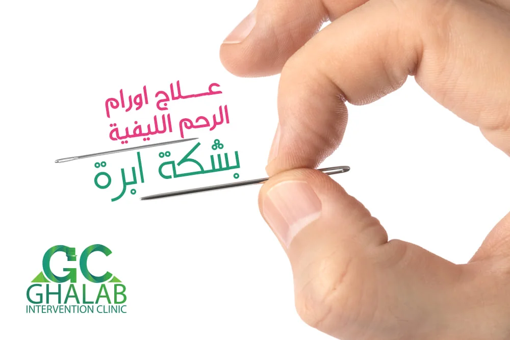 علاج الأورام الليفية بالأشعة التداخلية مع دكتور محمود غلاب