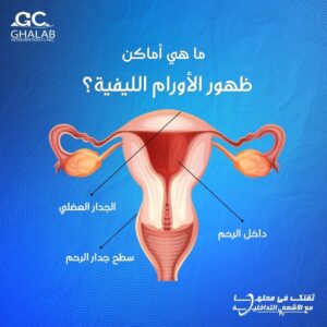 الأشعة التداخلية لعلاج الاورام الليفية