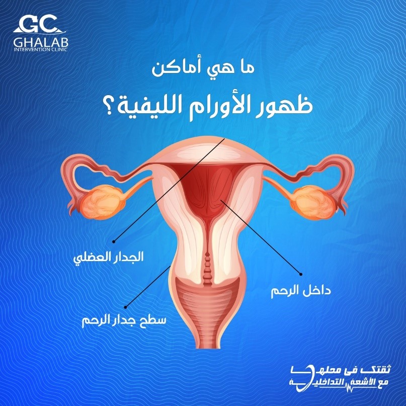 الأشعة التداخلية لعلاج الاورام الليفية