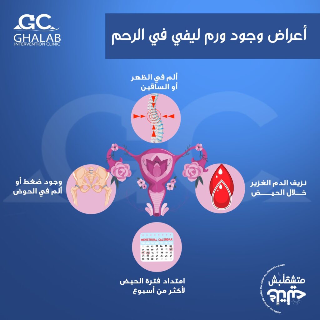 علاج اورام الرحم الليفية بالأشعة التداخلية