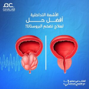 علاج تضخم البروستاتا بالأشعة التداخلية