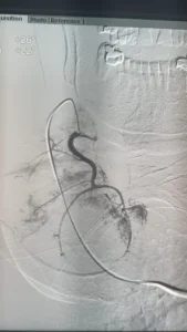 إنجاز طبى مصرى جديد بقيادة الدكتور محمود غلاب فى علاج تضخم الغدة الدرقية دون جراحة