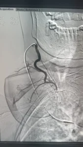 ريادة مصرية فى الأشعة التداخلية: الدكتور محمود عبد العزيز غلاب يبتكر أسلوبًا متقدمًا لعلاج تضخم الغدة الدرقية بالقسطرة الشريانية