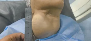 من أجل طبٍّ أكثر دقة و رحمة.. الدكتور محمود غلاب يقود ثورة علاجية في تضخم الغدة الدرقية بالأشعة التداخلية