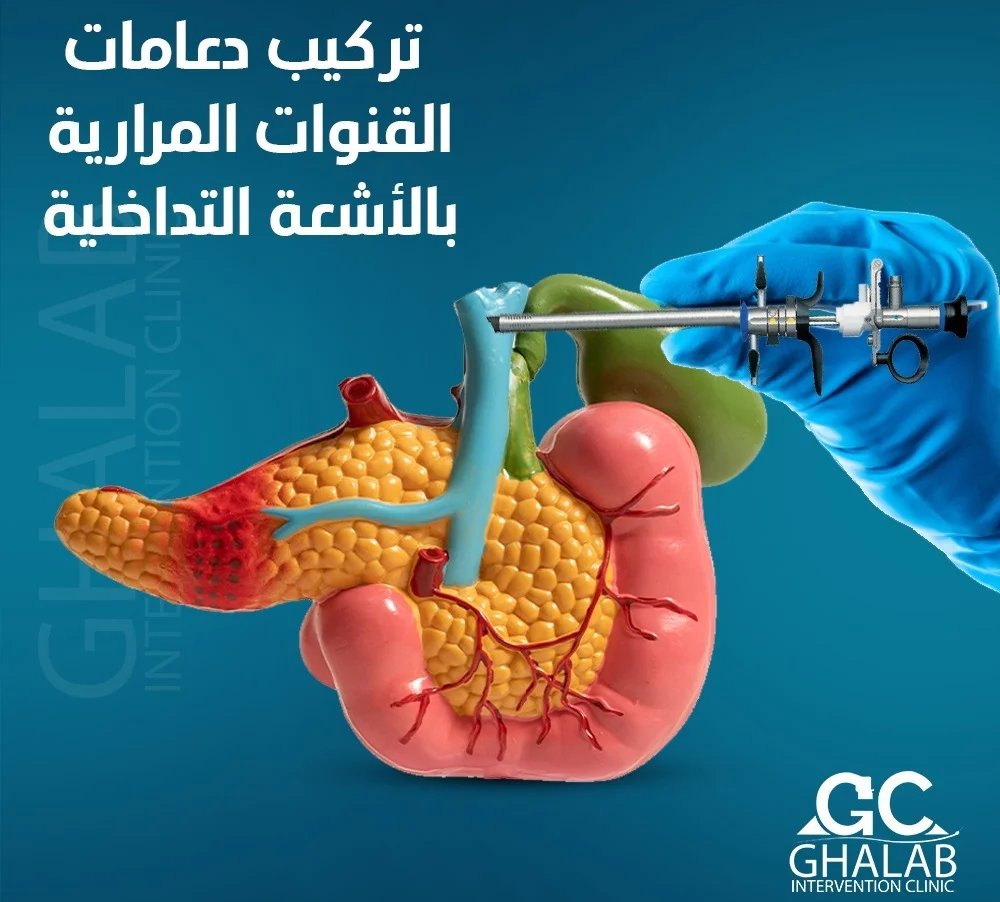 أسباب حصوات المرارة