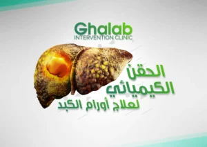 العلاج الحديث لأورام الكبد الخبيثة بالأشعة التداخلية و الحقن الشريانى و التردد الحرارى – بقلم د. محمود عبد العزيز غلاب الحقن الكيميائى لعلاج أورام الكبد