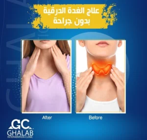 علاج الغدة الدرقية بالتردد الحرارى بدون جراحة | د. محمود غلاب