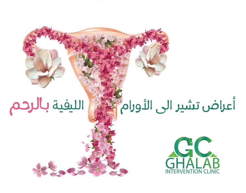 علاج الأورام الليفية بدون جراحة بالأشعة التداخلية | د. محمود غلاب