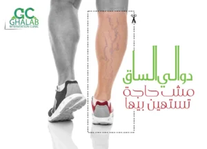 علاج دوالى الساقين بالأشعة التداخلية بدون جراحة | د. محمود غلاب
