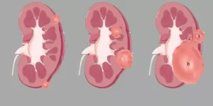 علاج أورام الكلى بالأشعة التداخلية | د. محمود عبد العزيز غلاب