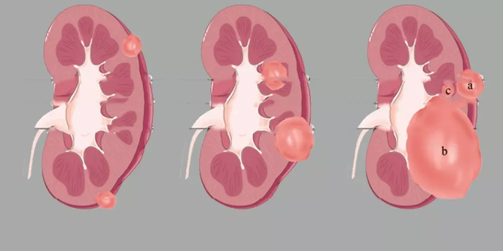 علاج أورام الكلى بالأشعة التداخلية | د. محمود عبد العزيز غلاب