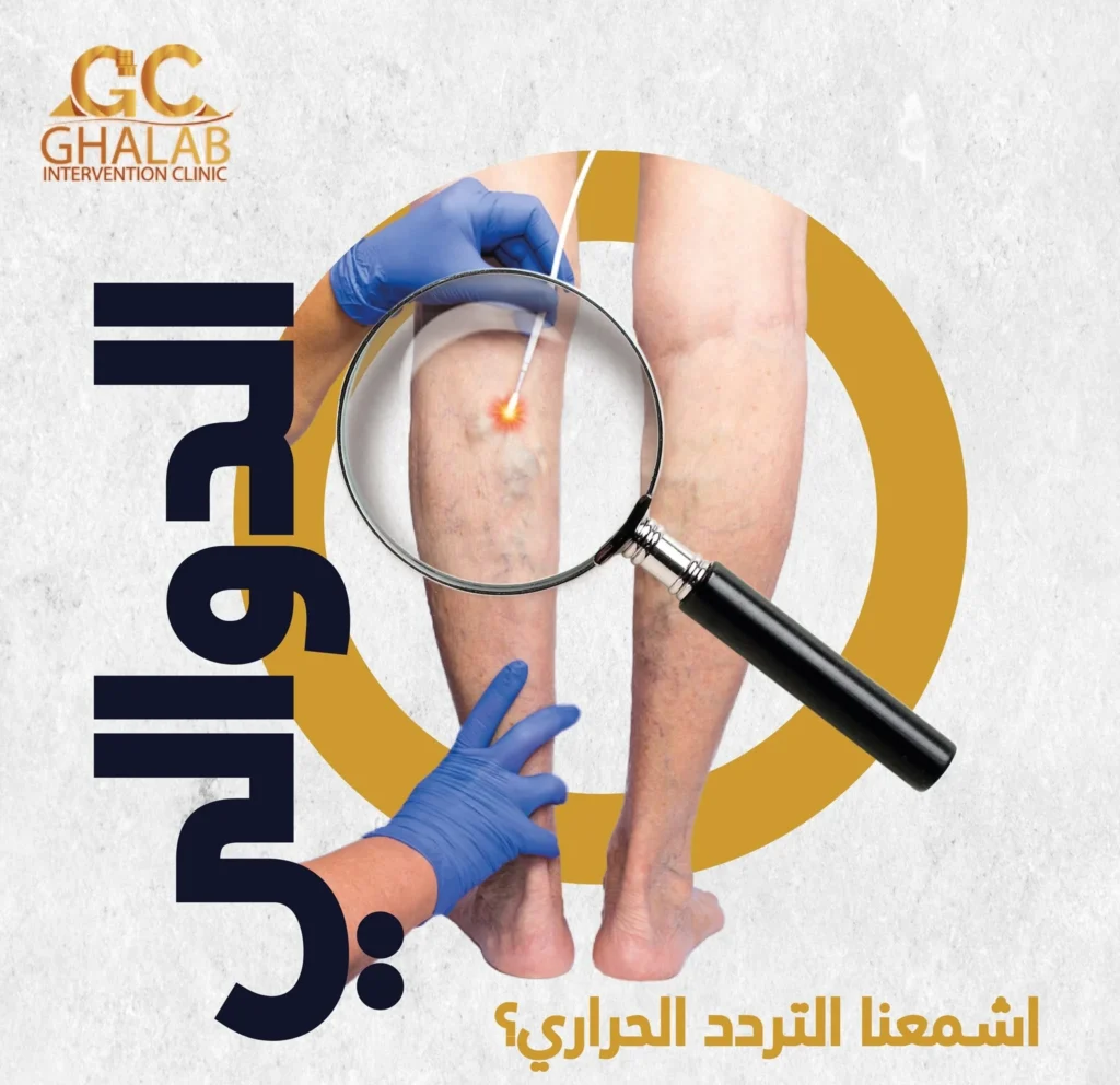 أحدث علاج لدوالى الساقين بدون جراحة | د. محمود غلاب