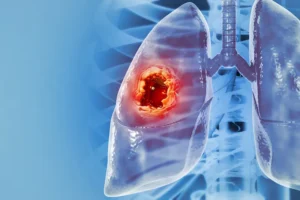 تميّز الدكتور محمود عبد العزيز غلاب فى علاج أورام الرئة بالتردد الحرارى و الميكروويف