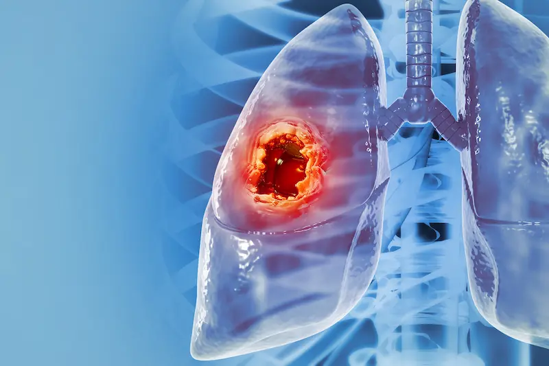 تميّز الدكتور محمود عبد العزيز غلاب فى علاج أورام الرئة بالتردد الحرارى و الميكروويف