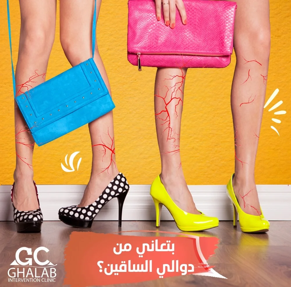 علاج دوالى الساقين فى الإسكندرية 2026| أحدث طرق القسطرة و الليزر و الجراحة مع د. محمود غلاب