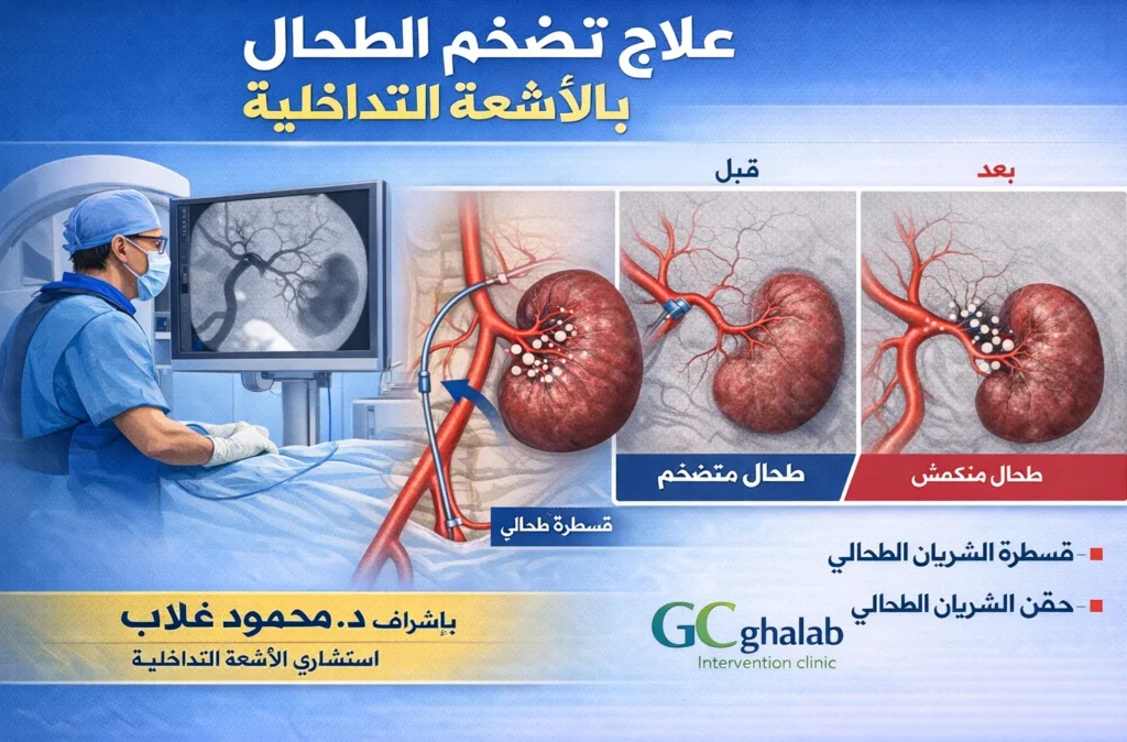 علاج تضخم الطحال بالأشعة التداخلية | د. محمود غلاب