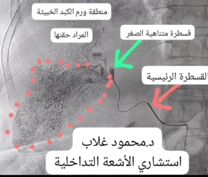 أسعار الأشعة التداخلية فى مصر: بين الجودة و التكلفة و خبرة الطبيب | د. محمود غلاب أفضل استشارى أشعة تداخلية فى مصر