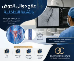 علاج دوالى الحوض و الرحم بالأشعة التداخلية بدون جراحة | د. محمود غلاب