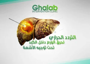 التردد الحرارى لحرق الورم داخل الكبد تحت توجيه الأشعة التداخلية| أفضل علاج سرطان الكبد و بؤر الكبد الحميدة بدون جراحة 2026 | د. محمود غلاب
