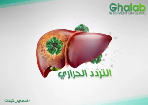 التردد الحرارى لأورام الكبد 2026 | الفرق بين الورم الحميد والخبيث و أفضل علاج بدون جراحة لبؤر الكبد الحميد| د. محمود غلاب