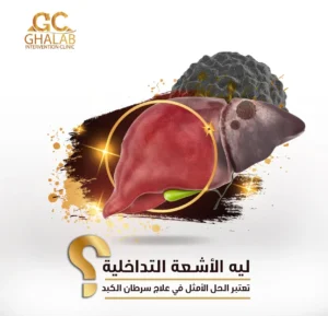طرق علاج وحمة الكبد بالأشعة التداخلية