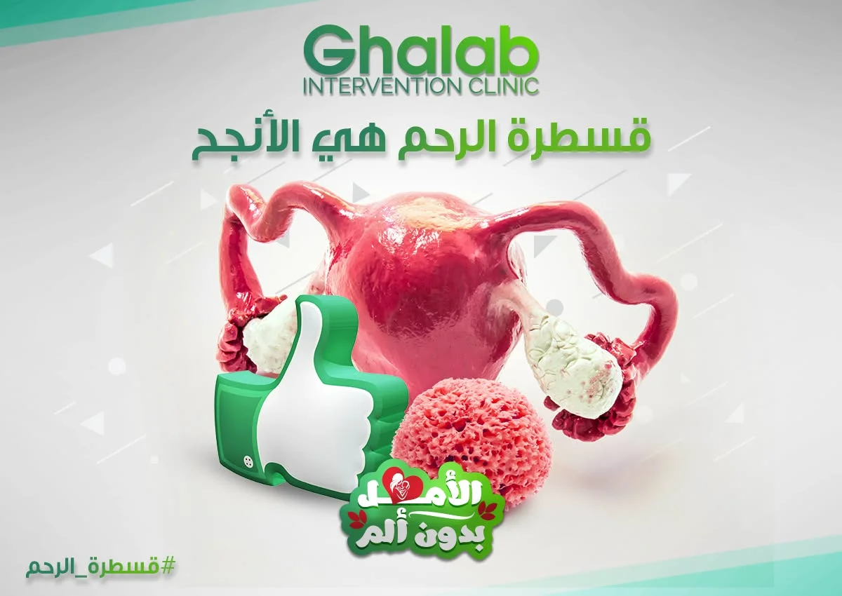 قسطرة الرحم لعلاج الأورام الليفية 2026: علاج فعال بدون جراحة ومتى تحتاجين إليها؟ | د. محمود غلاب