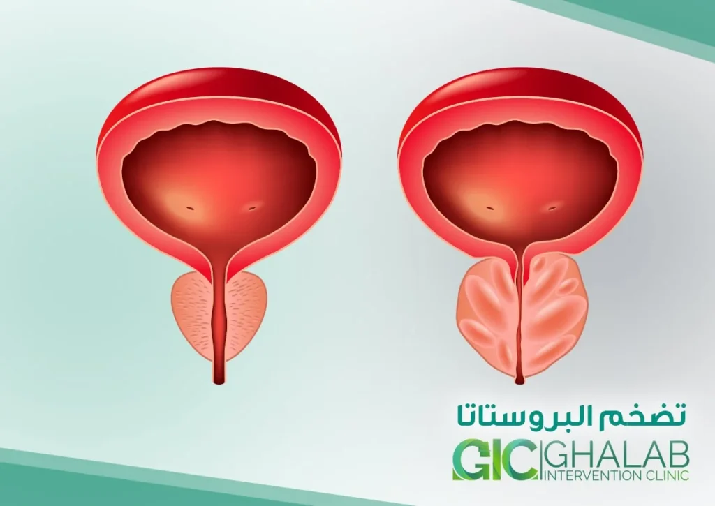 قسطرة شرايين البروستاتا