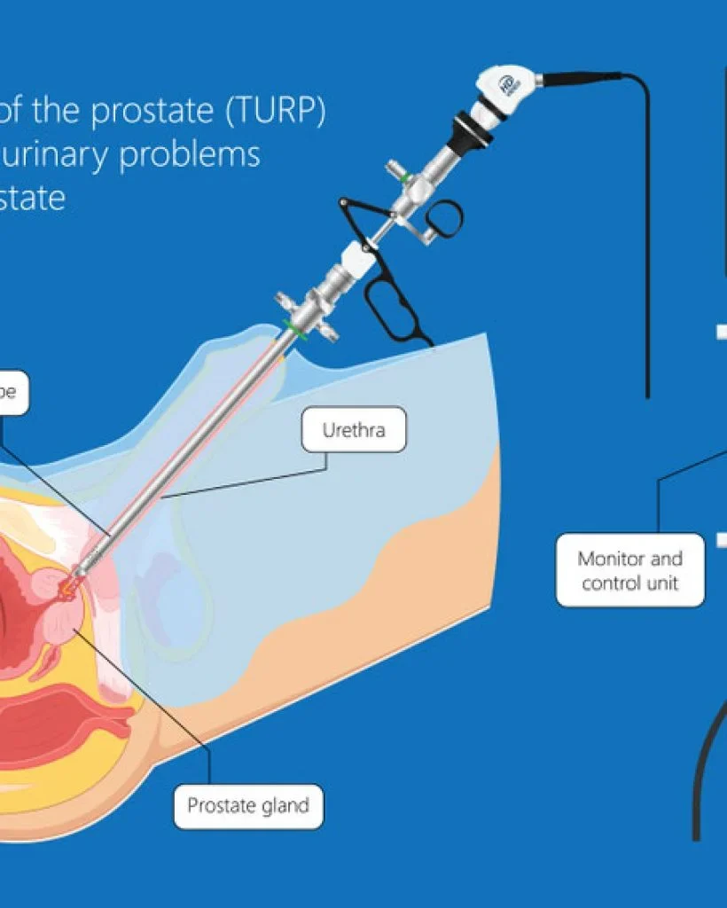 علاج تضخم البروستاتا بالأشعة التداخلية