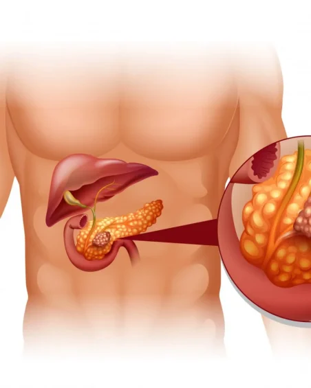 أورام الكبد | د. محمود غلاب